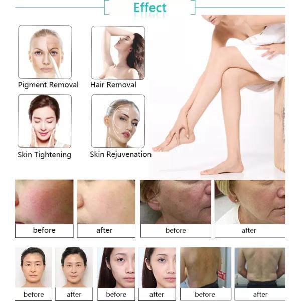 Nubway 3 in 1 beauty equipment E light IPL SHR hair removal machine with ipl laser