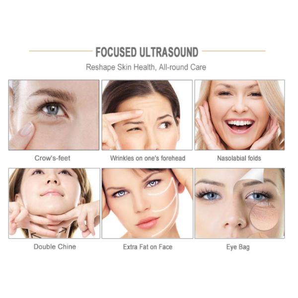 3.0mm 4.5mm Cartridge Non Surgical Face Lift Machine Radar Line Carve