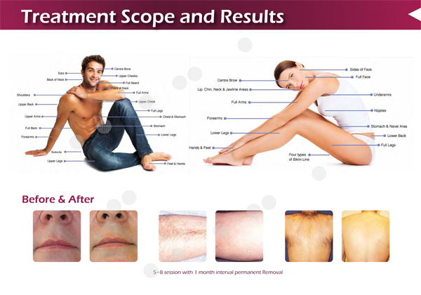 Max 10Hz Diode laser in motion hair removal machine for men and women