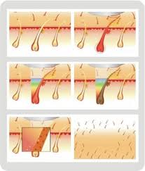 high performance 808 diode laser hair removal machine for total painless hair removal