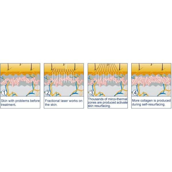RF Tube Co2 Fractional Laser Machine 360 Degree Scanning Ability Skin Rejuvenation