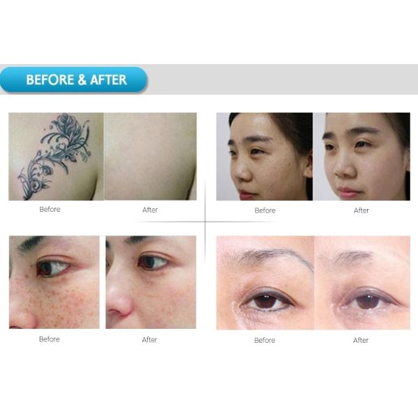 Машина удаления татуировки Nd Yag длины волны 1064nm случая 3 вагонетки