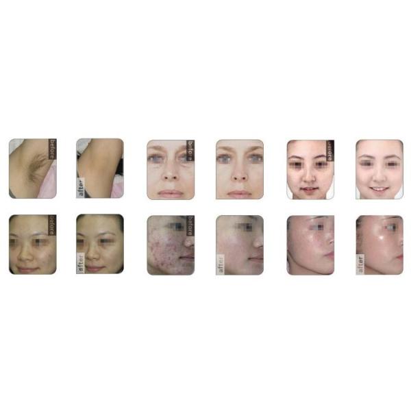 beauty equipment multifunctional 3 in 1 Permanent e-light xenon lamp elight shr lase ipl hair removal machine