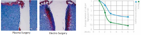 Tonsillectomy Plasma Wand ENT Probe for Plasma Surgery in Tonsillectomy Effective for Treating Repeated Acute Attacks of Chronic Tonsillitis
