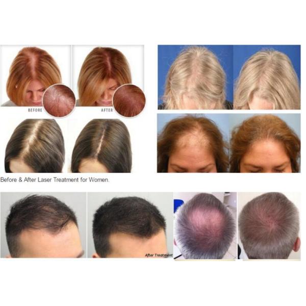 Биологическая машина восстановления волос лазера, машина роста волос обработки скальпа LLLT