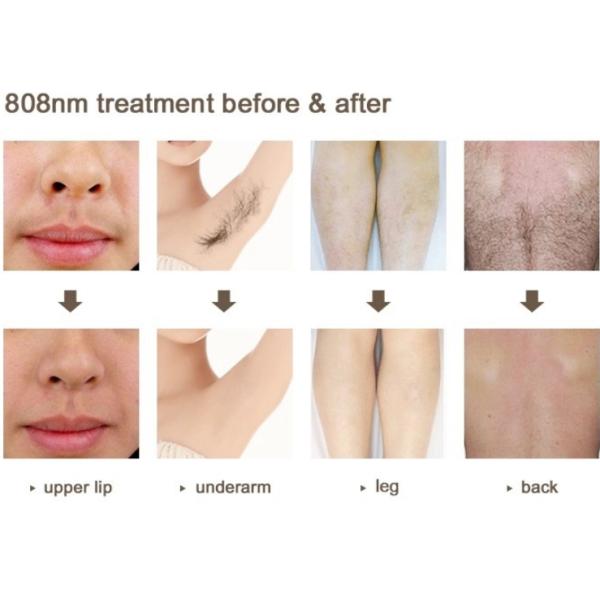 Оборудование красоты лазера диода 755 808 1064 подмолаживаний кожи удаления волос