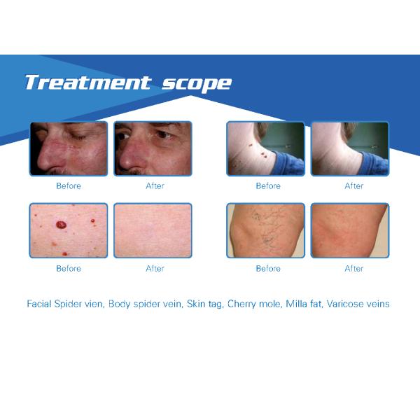 Portable 8 different spot sizes laser diode 980nm facial spider vein removal beauty equipment
