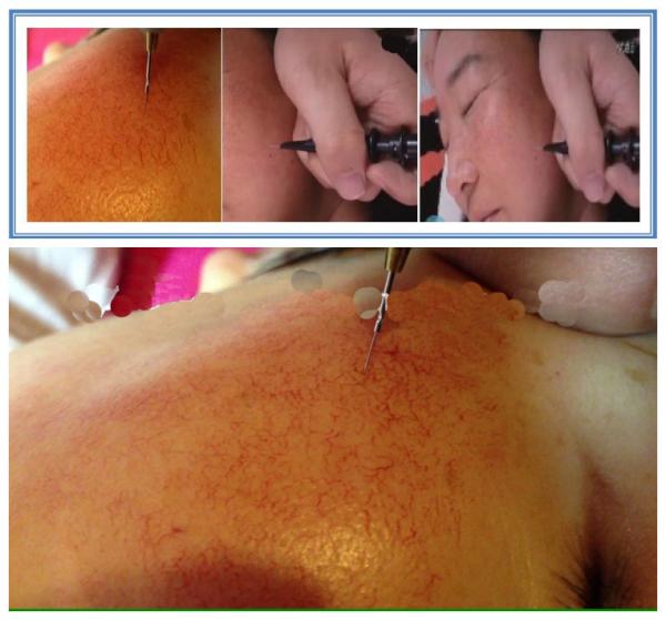 perfessional vascular removal machine skin tag&spider vein treatment device