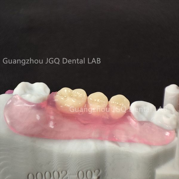 Valplast Flexible Denture Unique Material Flexibility Comfort Adapting to Mouth