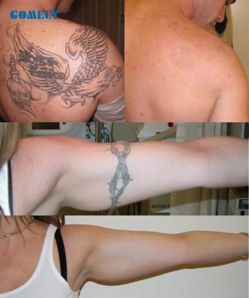 Picolaser Laser Tattoo Removal Machine with 2000W Q Switched Nd Yag
