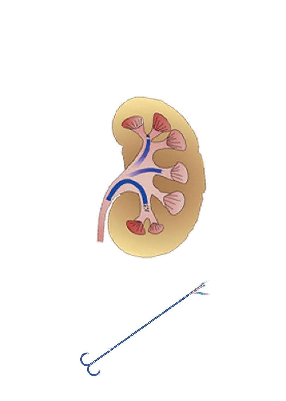 CE MDR Certification High Value Ureteral Access Sheath Endourology Practices Access Sheath Urology