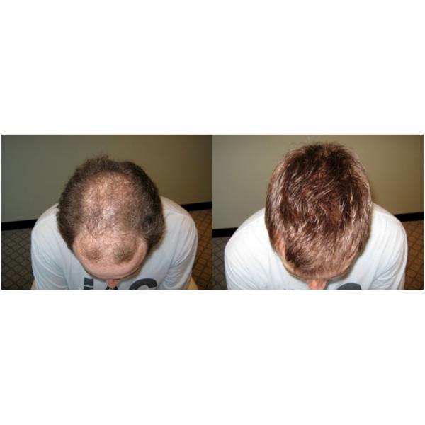 FDA Cleared Pro Laser Hair Regrowth Helmet 650nm 405mW Anti Hair Removal