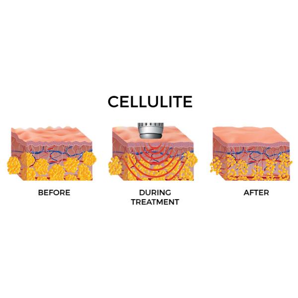 Терапия акустической волны красоты для источника Ген целлюлита 4рд магнитного электрического