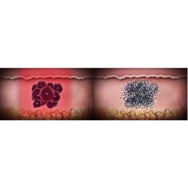 755nm Picosecond Yag Laser Tattoo Removal Machine Portable With Touch Screen