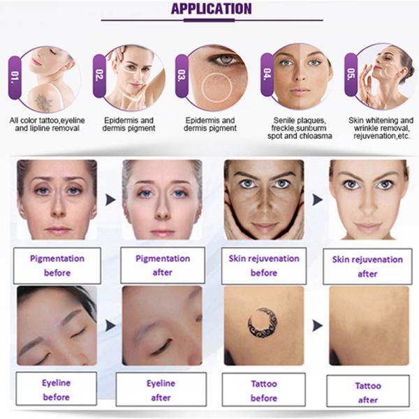 машина удаления татуировки лазера Nd Yag переключателя 532nm 1064nm 1320nm q