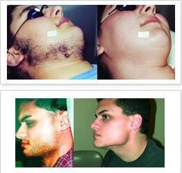 10 Million Shots Hair Removing Laser Machine Painless High Effective