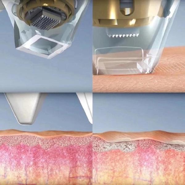 Машина лазера удаления шрама угорь машины RF Microneedling 2 ручек Nano