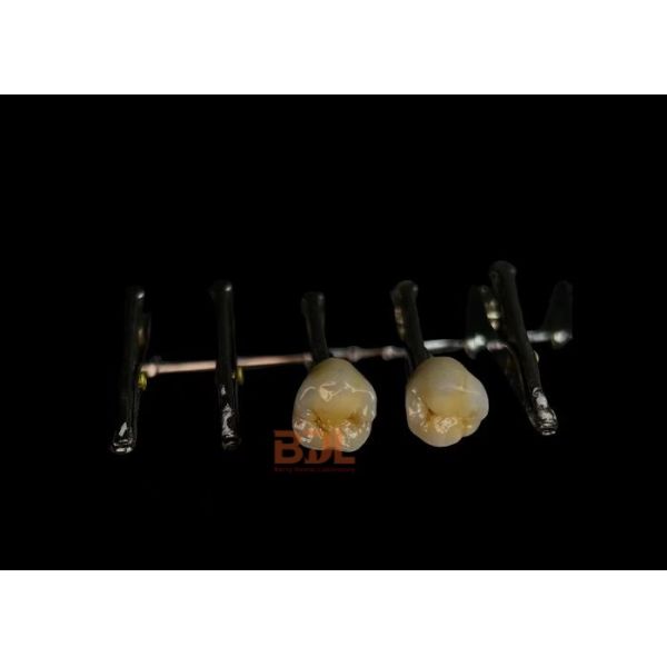 Strong Metal Ceramic Bond Porcelain Fused To Metal Dental Restoration Good Biocompatibility
