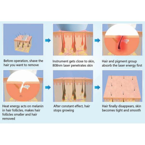 mini 808nm diode laser hair removal machine for home use
