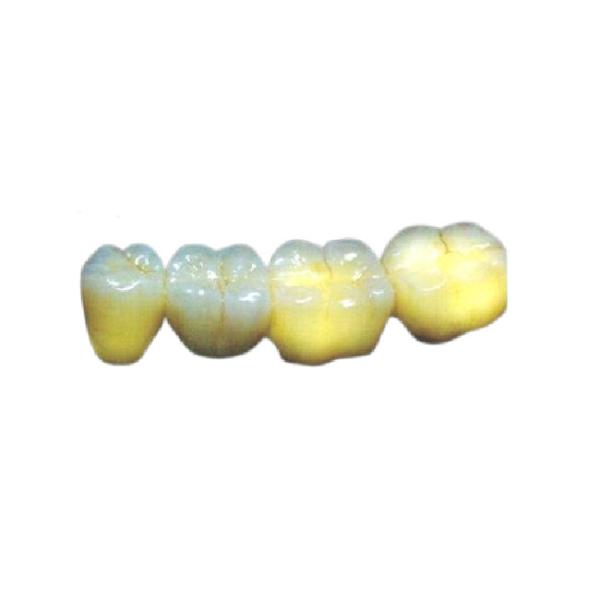 Wear Resistant PFM Dental Crown High Strength Aesthetic Allergy Friendly