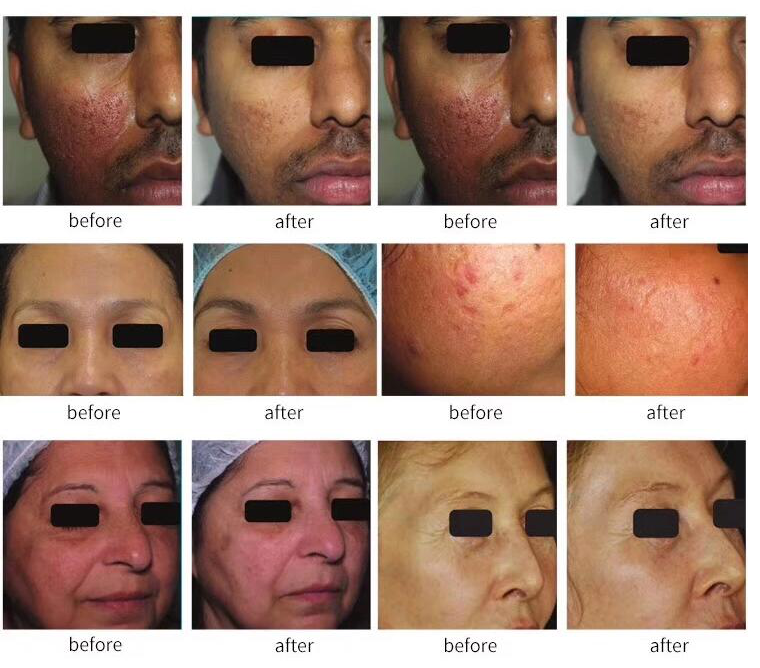 Термальное частичное удаление шрама машины RF Microneedle