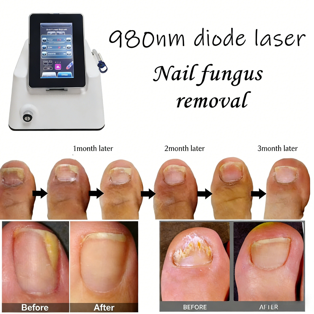 980nm Diode Laser Machine , Nail Fungus Laser Machine 30W With 7 Inch Touch Screen