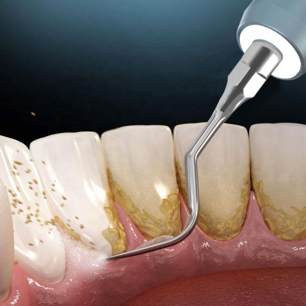 Зубы чистя Дурабле ультразвуковой машины скалера многофункциональное