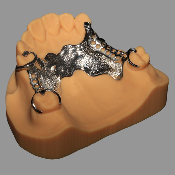 3D Printed CoCr Metal Framework Partial Nickel Free Lightweight