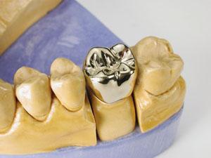 Cobalt Chromium Alloy Dental Crown with CAD/CAM Milling for High Tensile Strength and Permanent Restoration