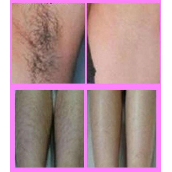 Non - Invasive Permanent 640 - 950 nm SHR Face Hair Remover Machine