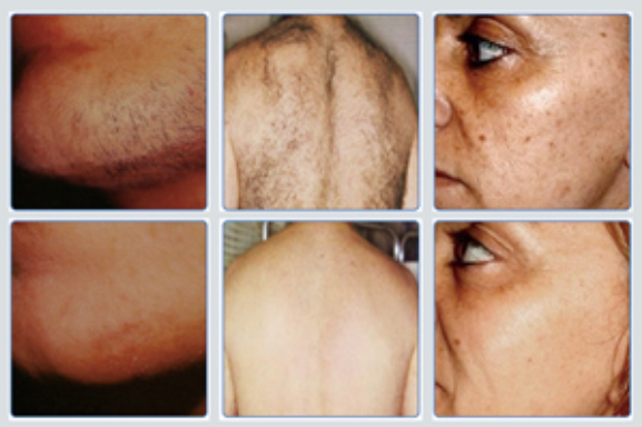 Professional IPL Beauty Machine For SHR Hair Removal OPT FP Model