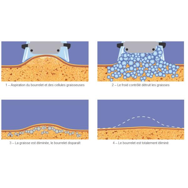 Машина Крйо жирная замерзая Крйолиполысис 360 градусов для высокой эффективности потери веса