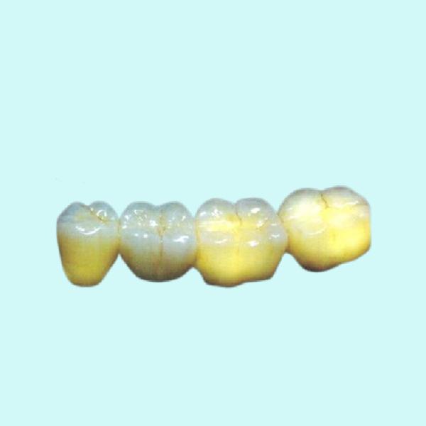 Wear Resistant PFM Dental Crown High Strength Aesthetic Allergy Friendly