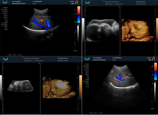 Ультразвук цифров машины Ultrasonography медицинского цвета 4D Eco портативный