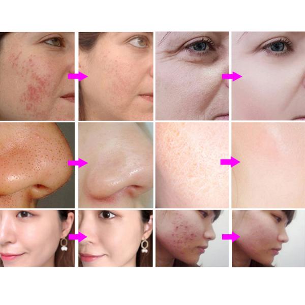 Portable Hyro H2o2 Small Bubble Hydra Aqua Peel Facial Machine 10 in 1