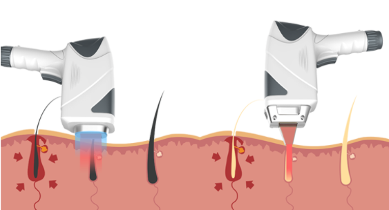 808nm Fast SHR Hair Removal Machine True Uk Lamp Permanent 1 Million Shots Life