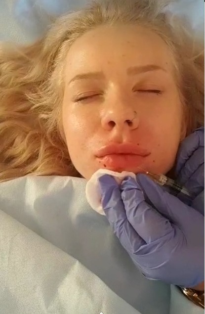 Впрыска 2мл заполнителя ХА дермальная для повышения губы/лицевых обработок морщинки