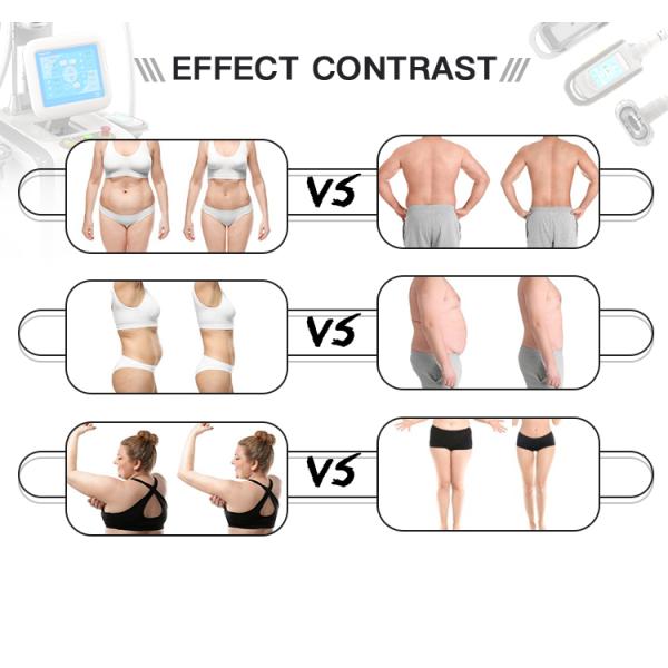 Function 2 Criolipolisis Machine Cryolipolysis for Safe and Non-Invasive Fat Removal