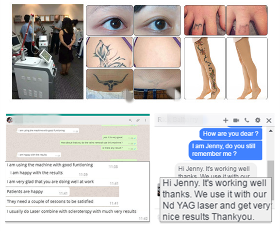 innovative products 2018 1064nm 532nm q-switched nd yag laser tattoo removal machine for tattoo melasma removal