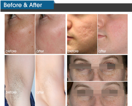 2000w IPL Hair Removal Device 560 Nm 640 Nm 1million Shots Life Time