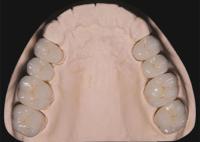 Restauration dentaire Dents Circonia couronnes dentaires fabriquées par laboratoire dentaire en Chine