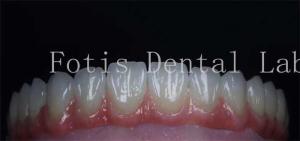 Smooth Surface Cosmetic Tooth Coverings Natural Porcelain Veneers Customizable
