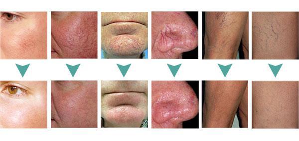 30Mhz High frequency new ! High Frequency spider veins remover RBS Vascular machine