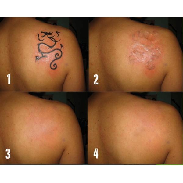 Популярное лечение лазерное удаление татуировки пико эффективная черная кукла