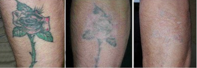 532/1064nm Portable Q Switch  Nd Yag Laser Tattoo Removal Beauty machine with Cart and Carbon skin rejuvenation tip