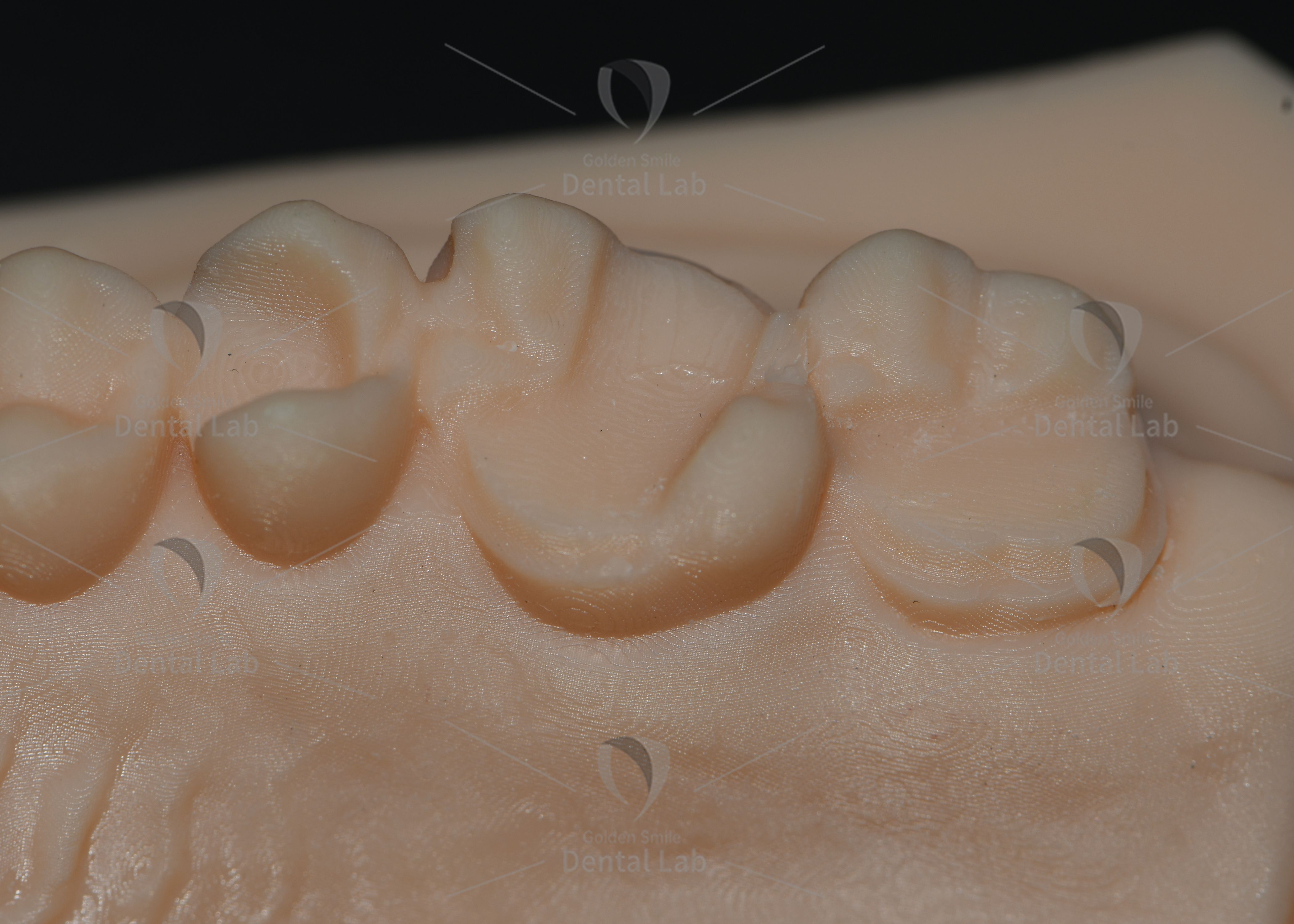 Biocompatible Lithium Disilicate Pressed Ceramic Inlays with Natural Aesthetics for Minimally-invasive Dental Restoration