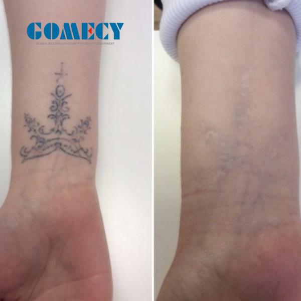 Picosecond Laser Tattoo Removal Machine Nd Yag Tattoo Remove Machine Picolaser Laser Pico Q-switch Carbon Laser Peel Machine