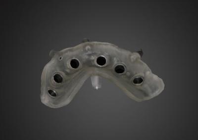 Surgical sguide Plan for Implant Supported Crown Design and Alveolar Bone Information