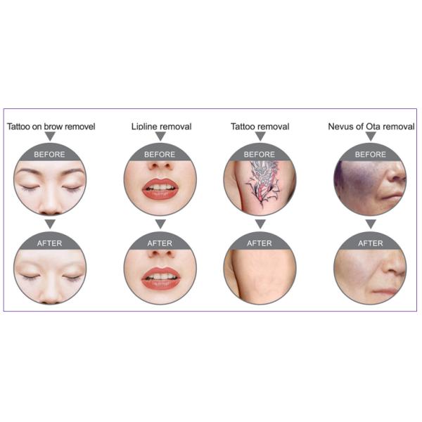Portable Q - Switched Tattoo Laser Removal Equipment With Adjustable Treatment Probes