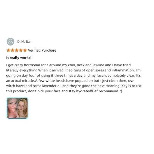 Antimicrobiano Peróxido de benzoilo Acné espumante Limpieza facial sin olor